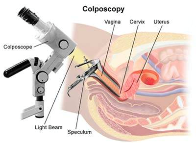 Colposcopy